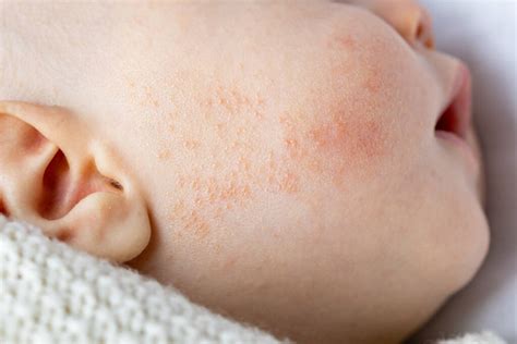 positon crema bebes|Le traitement de l’eczéma du nourrisson